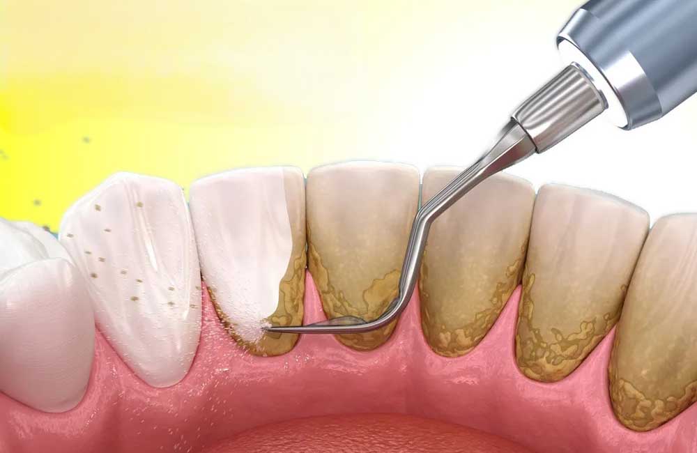 Teeth Whitening in Patna